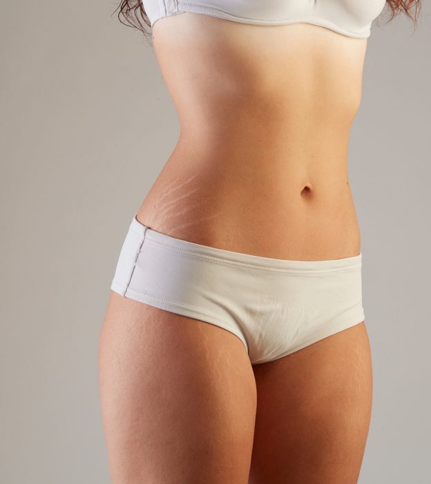 5 Ways To Treat Stretchmarks In Teenagers