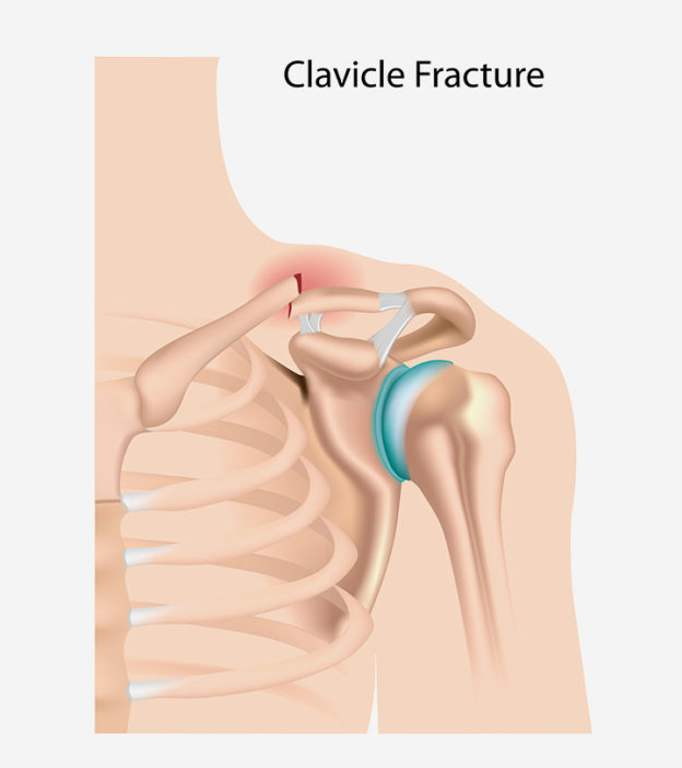 Broken Collarbone (Clavicle Fracture) In Child: Causes, Symptoms, And Treatment