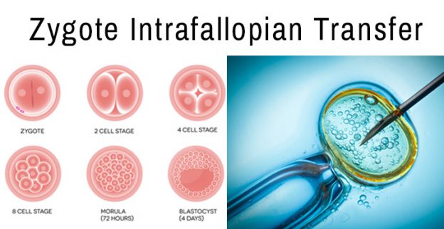 Infertility Treatment - Zygote Intrafallopian Transfer (ZIFT)
